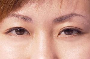気になる太田母斑とレーザー治療